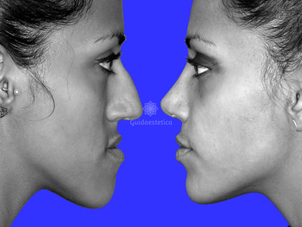 Esempio prima e dopo chirurgia maxillo facciale