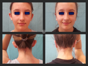 Prima e dopo otoplastica