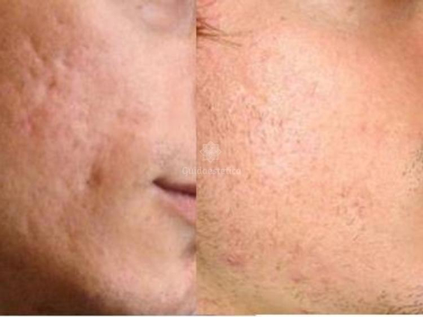 Miglioramento delle cicatrici acneiche dopo needling
