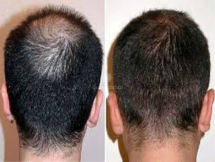 Trapianto capelli risultati prima e dopo