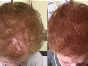 PRP effetti collaterali e controindicazioni