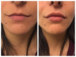 Risultati aumento labbra