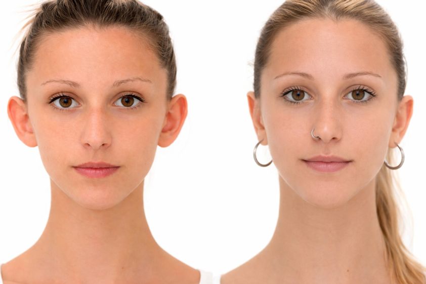Otoplastica