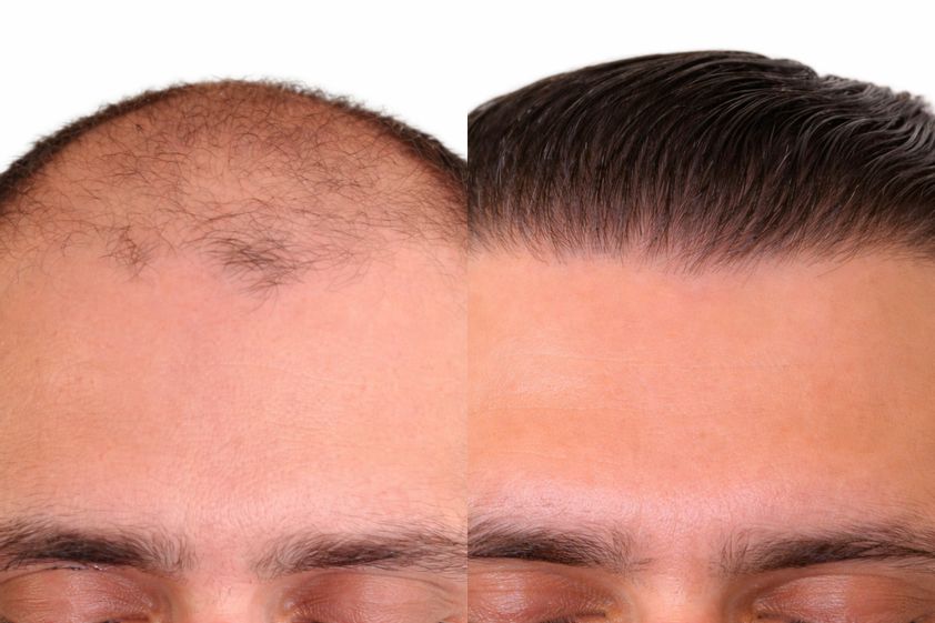 Trapianto capelli