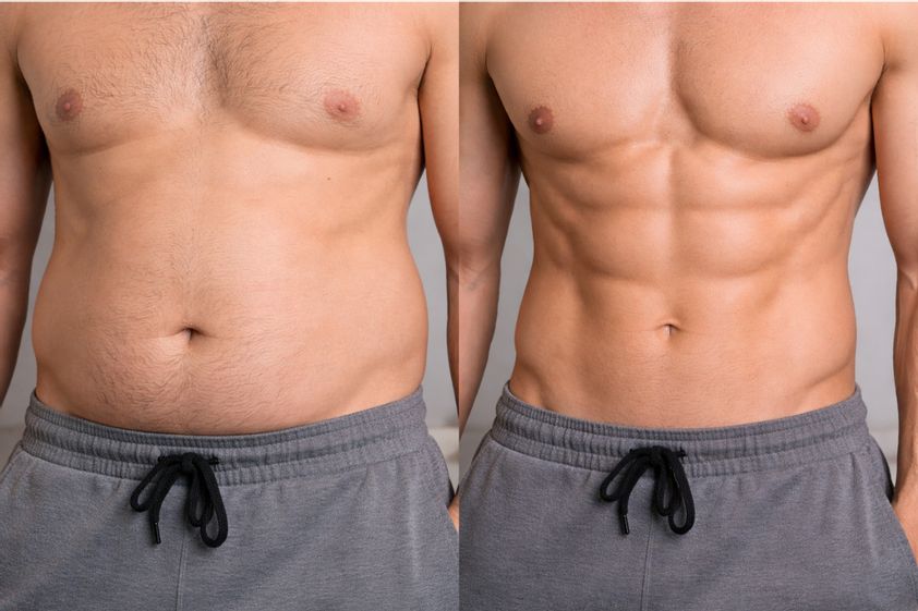 Liposcultura