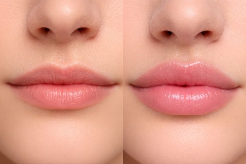 Filler labbra