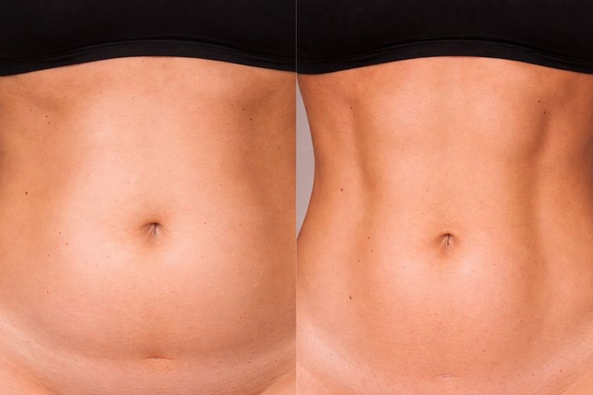 Lipo Vaser