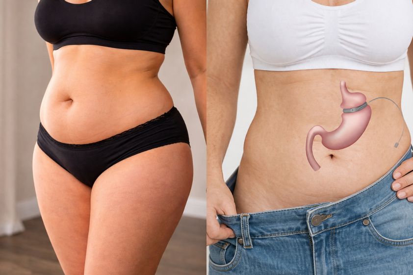 Bendaggio gastrico