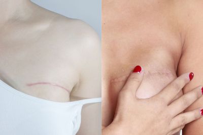 Prima e dopo di Ricostruzione mammaria