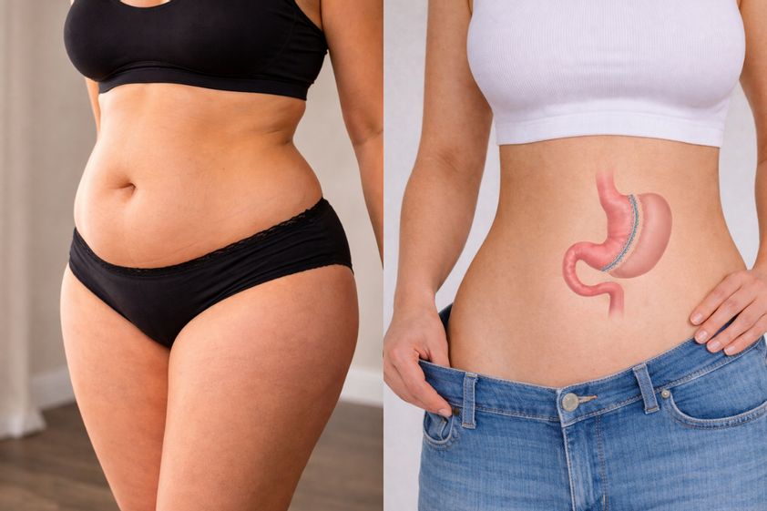 Sleeve gastrectomy