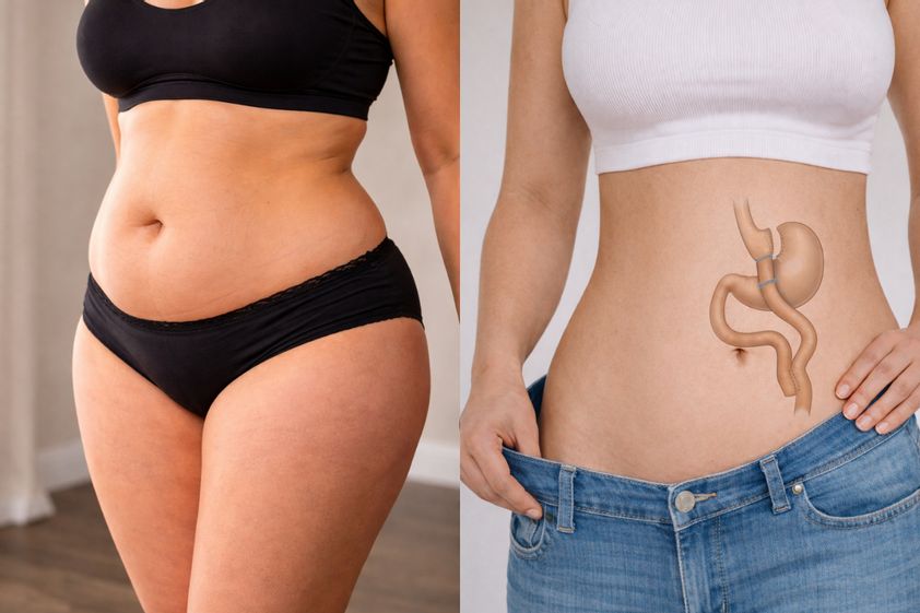 Bypass gastrico