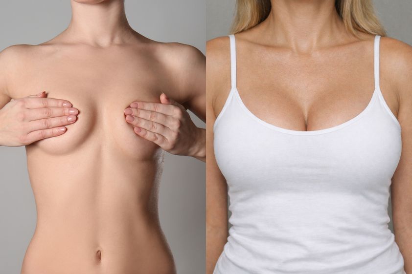 Lipofilling del seno