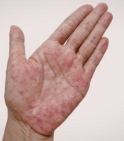 Psoriasi