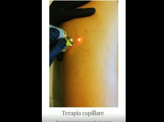 Terapia Capillare, Trattamiento vascolare per eliminazione capillari