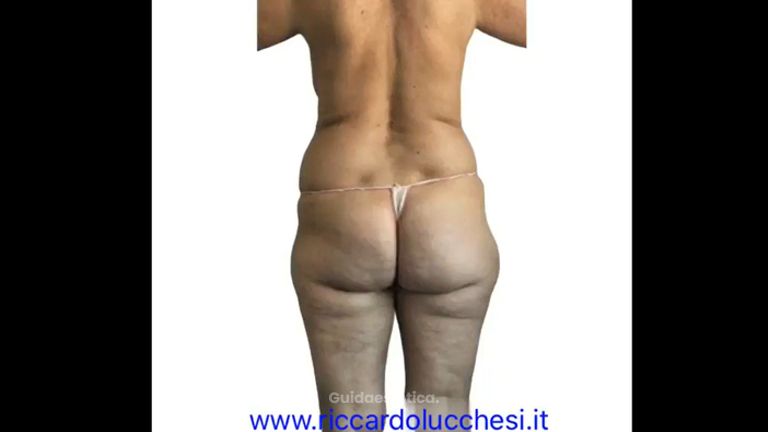 Liposuzione - Dott. Riccardo Lucchesi