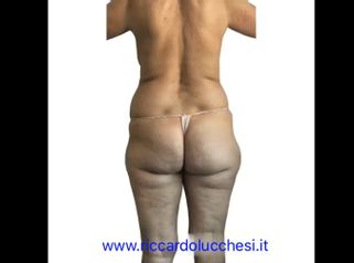 Liposuzione - Dott. Riccardo Lucchesi