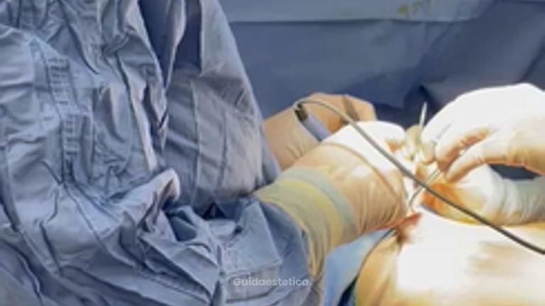 Dott. Alfio Scalisi - 4 Spa Medical Clinic Ginecomastia con Vaser Lipo
