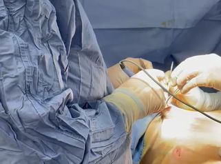 Dott. Alfio Scalisi - 4 Spa Medical Clinic Ginecomastia con Vaser Lipo