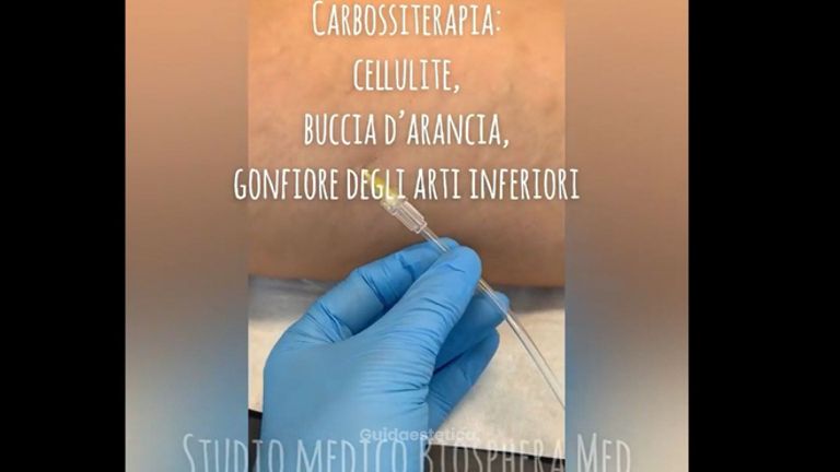 Carbossiterapia - Studio medico BiospheraMed
