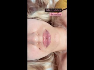 Filler labbra - Dott.ssa Paola Nardolillo