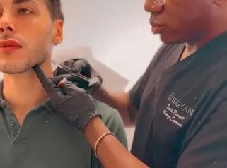 Dott. Benoit Menye Filler mandibolare uomo: definizione dell’ovale del viso