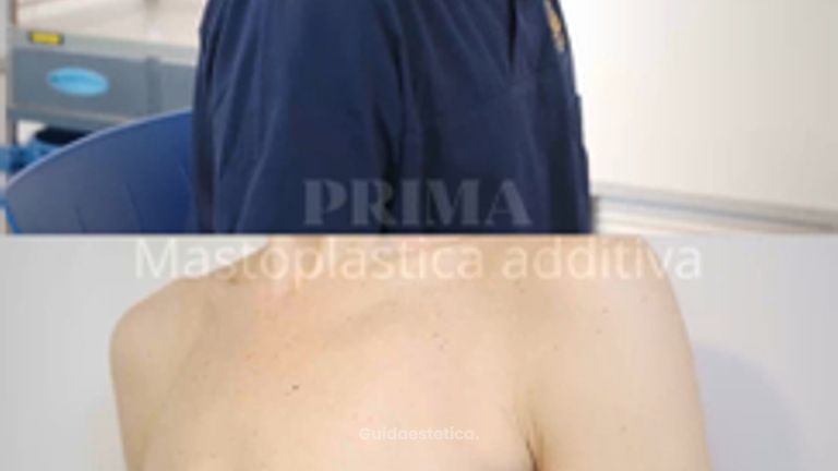SCEB Salute Chirurgia Estetica Benessere Mastoplastica additiva con tecnica scarless