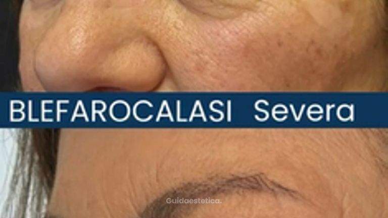 Dott. Alfredo Altieri Blefarocalasi severa e riduzione del campo visivo