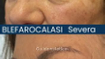 Dott. Alfredo Altieri Blefarocalasi severa e riduzione del campo visivo