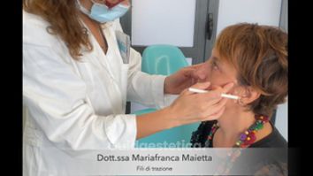 Fili riassorbibili - Dott.ssa Mariafranca Maietta