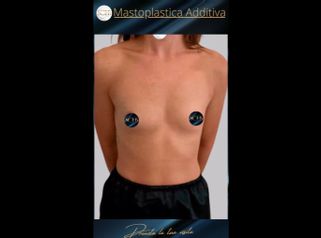 Mastoplastica additiva - SCEB Salute Chirurgia Estetica Benessere - Dott. Manuel De Giovanni