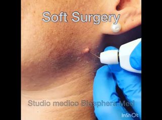 Verruche - Studio medico BiospheraMed