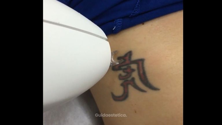 Rimozione tatuaggi - Dott. Alessandro Nube