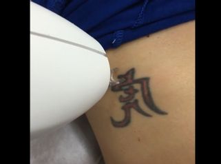 Rimozione tatuaggi - Dott. Alessandro Nube