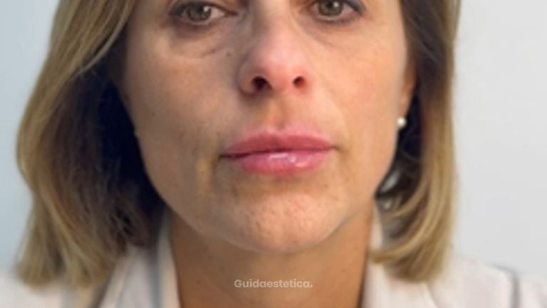 Dott.ssa Sara Carinci Video del risultato finale di un filler labbra