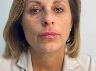 Dott.ssa Sara Carinci Video del risultato finale di un filler labbra