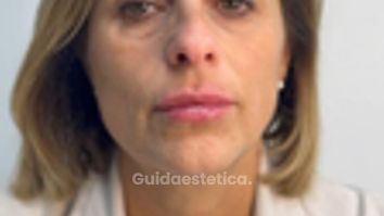 Dott.ssa Sara Carinci Video del risultato finale di un filler labbra