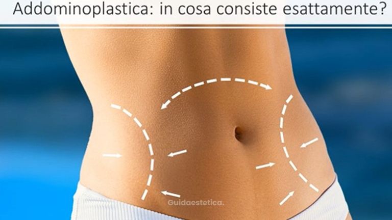 Addominoplastica