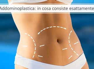 Addominoplastica