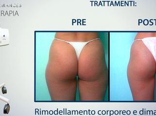 Carbossiterapia - Dott.ssa Loredana Gatto
