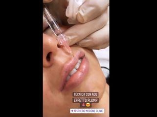Filler labbra eseguito con tecnica verticale (russa) - Dr. Luca Zattoni