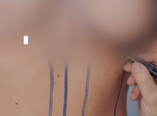 Dott. Arturo Amoroso Mastoplastica e Lipofilling