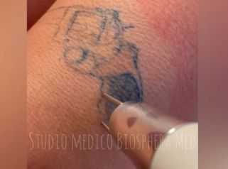 Rimozione tatuaggi - Studio medico BiospheraMed