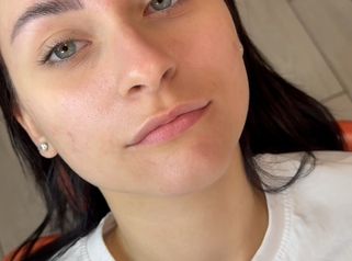 Dott.ssa Sara Carinci Equilibrio e volume: trasformazione labbra con filler
