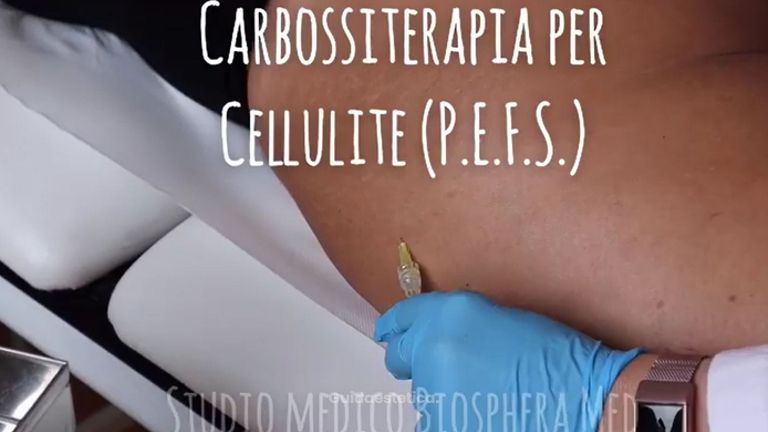 Carbossiterapia - Studio medico BiospheraMed