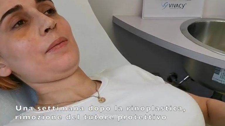 Rinoplastica - Dott. Francesco Alia