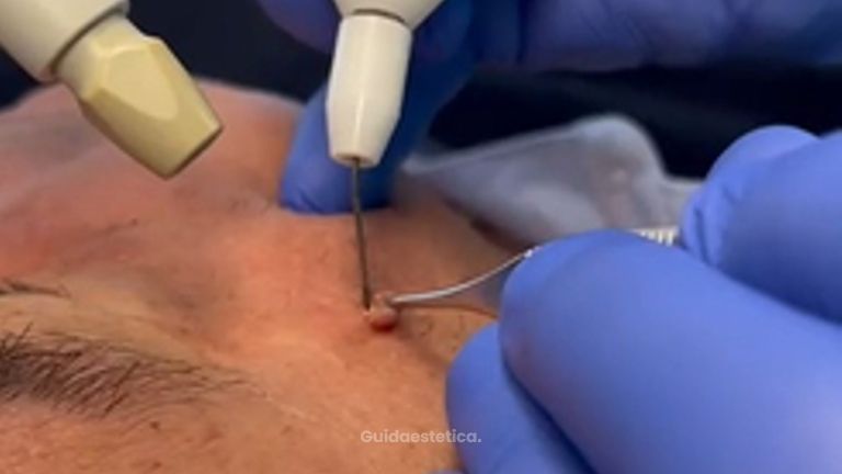 Studio Medico Brenno Franceschini Fibroma della pelle rimosso con il plasma 2