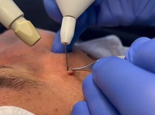Studio Medico Brenno Franceschini Fibroma della pelle rimosso con il plasma 2