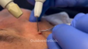 Studio Medico Brenno Franceschini Fibroma della pelle rimosso con il plasma 2