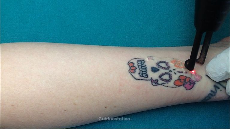 Medicina Estetica Cotilli: Rimozione dei tatuaggi