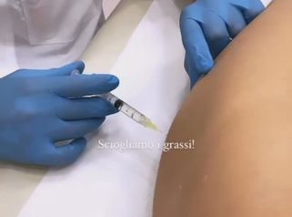 Liposuzione non Chirurgica